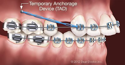 Affordable Braces in Rotorua: Understanding the Cost and Treatment Options